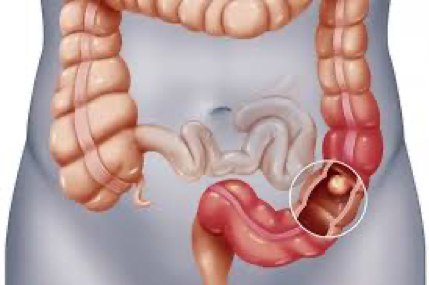 polyp đại tràng.png